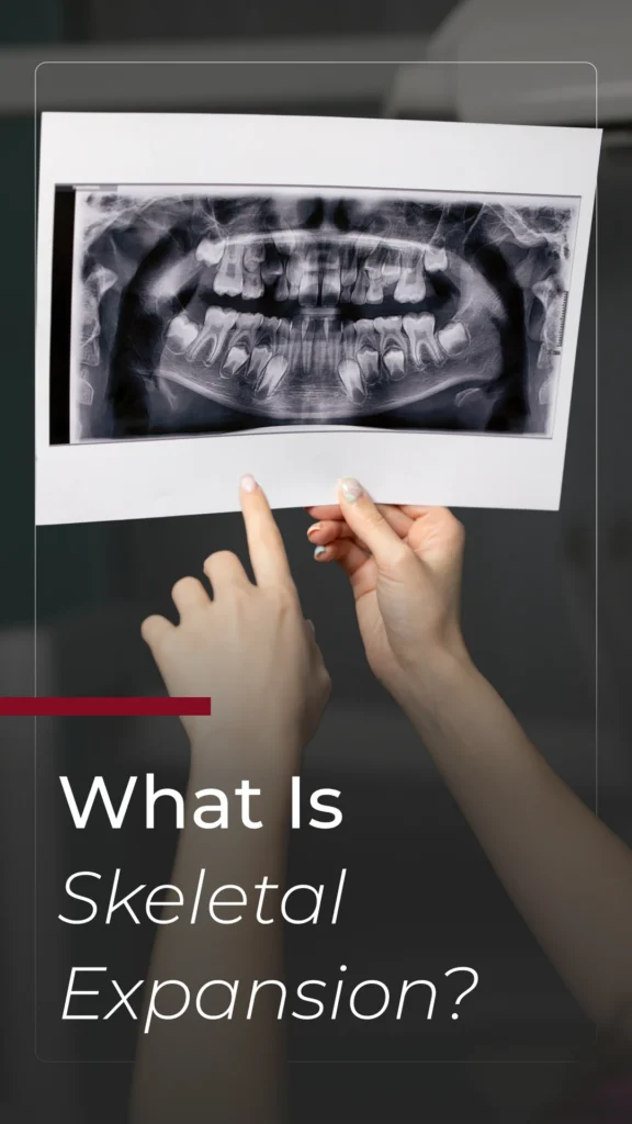 What Is Skeletal Expansion?