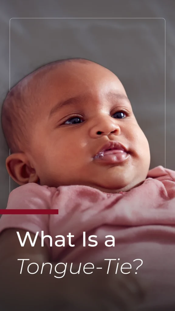 What Is a Tongue-Tie?